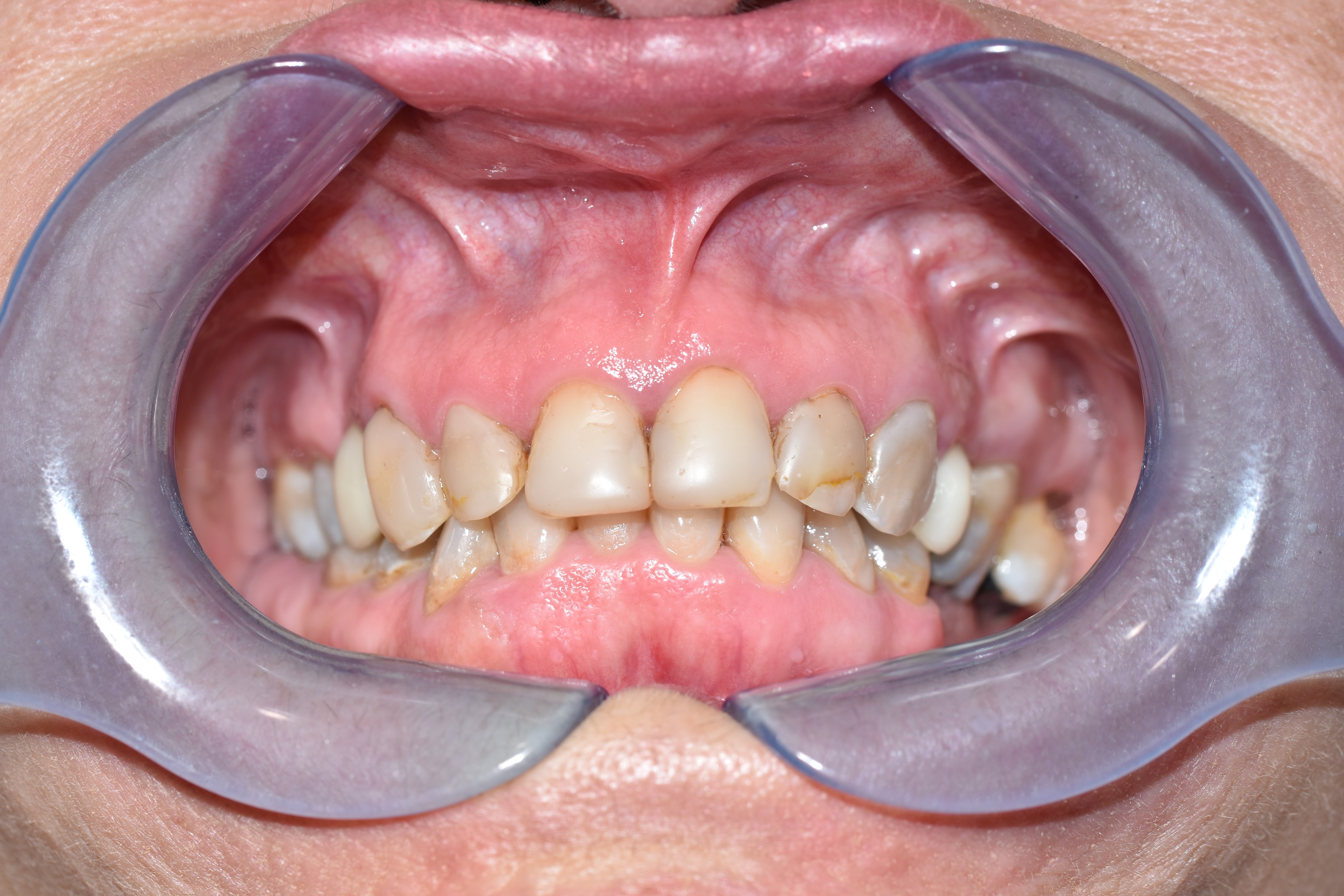 Before treatment